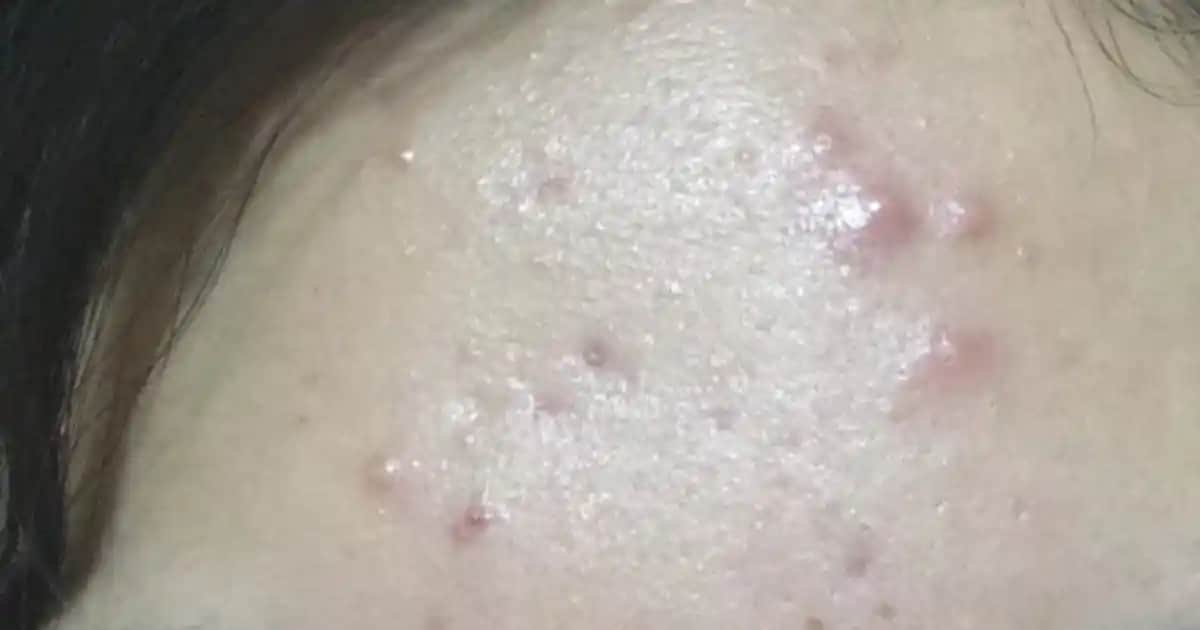 Alnınızdaki Sivilcelerin Nedenleri ve Etkili Çözüm Yolları Hakkında Detaylı Bilgi