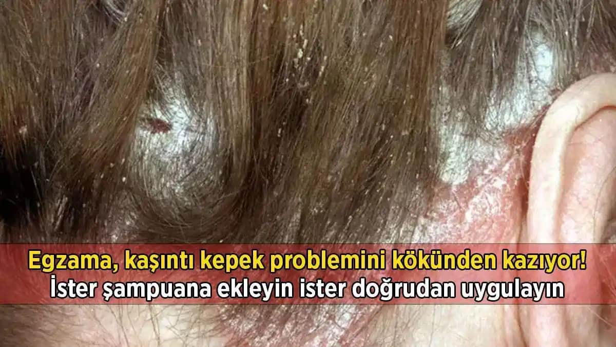 Aşırı Kepek ve Kaşıntı Problemlerine Karşı Etkili Çözüm Yolları ve Saç Sağlığı İpuçları