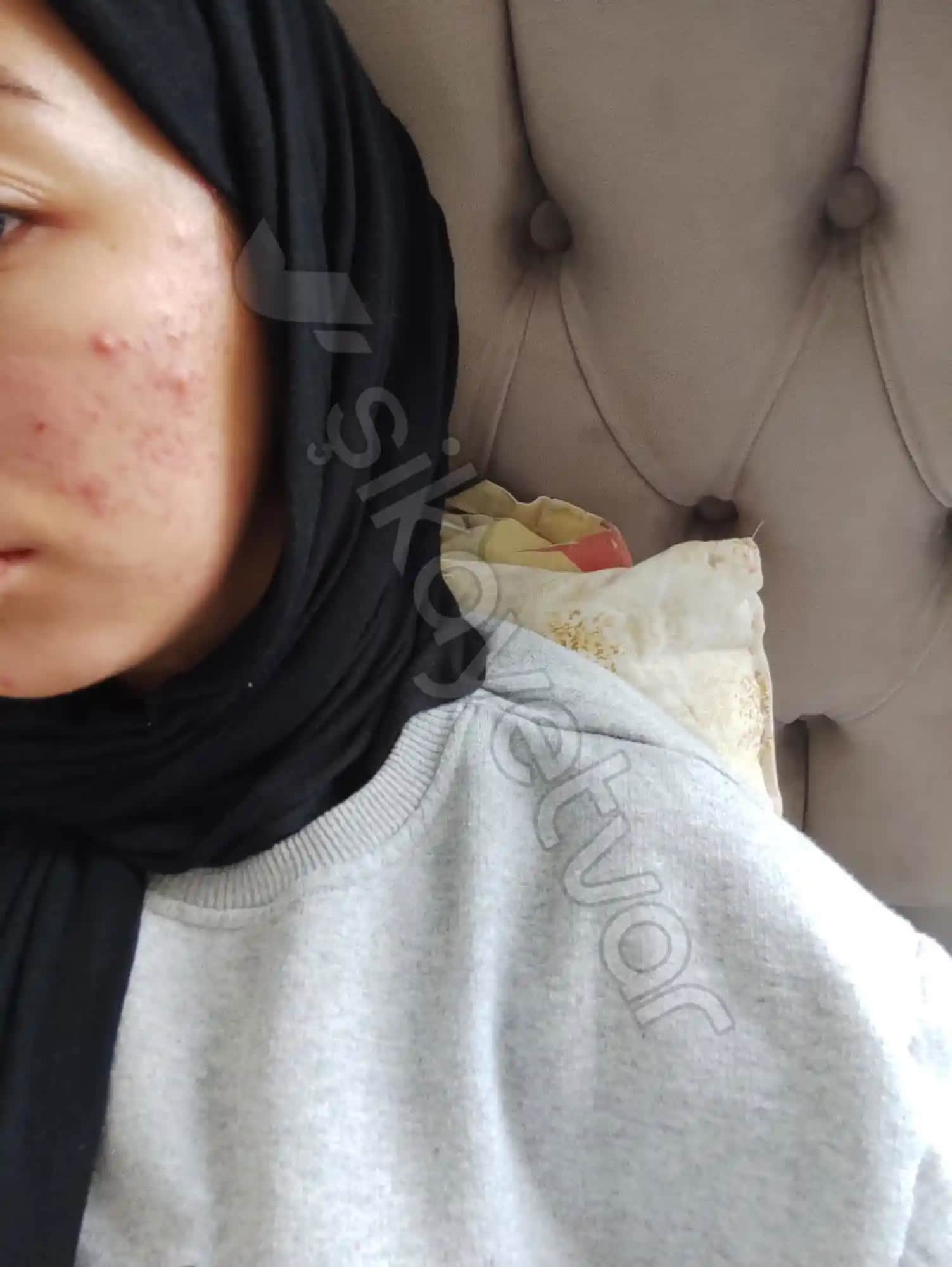 Aşırı Sivilcelenme Nedenleri ve Etkili Cilt Bakım Yöntemleri Hakkında Kapsamlı Rehber