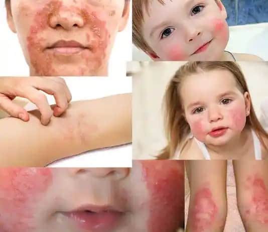 Atopik Dermatitte Doğru Cilt Bakımı ve Kozmetik Ürün Seçimi Rehberi