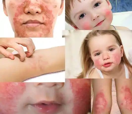 Atopik Dermatitte Doğru Cilt Bakımı ve Kozmetik Ürün Seçimi Rehberi