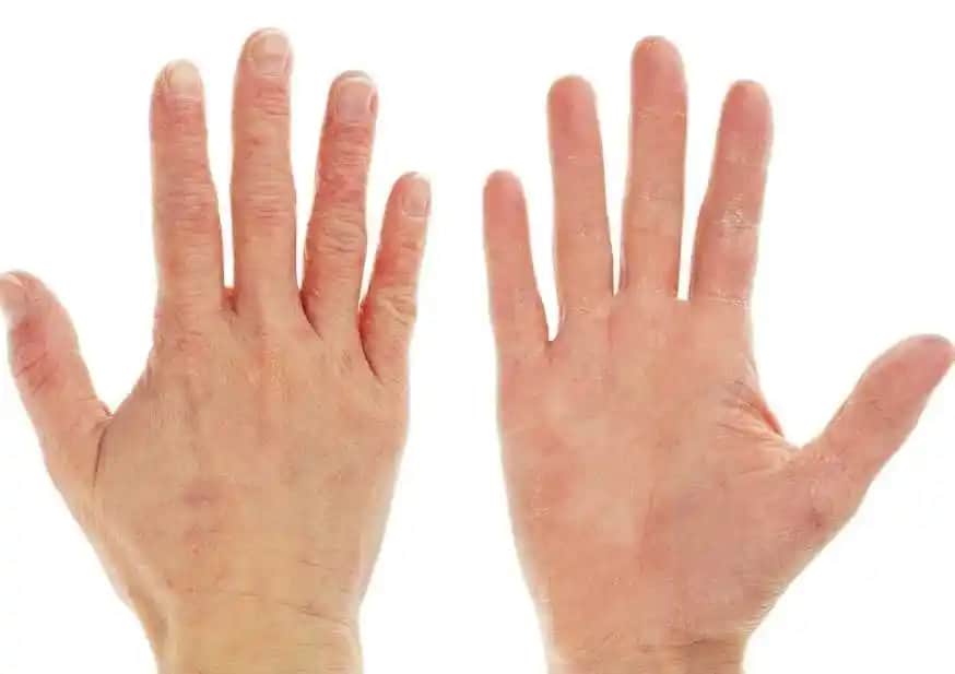 Avuç İçi Egzama Nedenleri Belirtileri ve Etkili Bakım Yöntemleri Hakkında Kapsamlı Bilgi