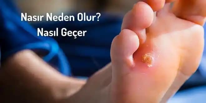 Ayak Altı Nasırına İyi Gelen Doğru ve Etkili Çözüm Yöntemleri