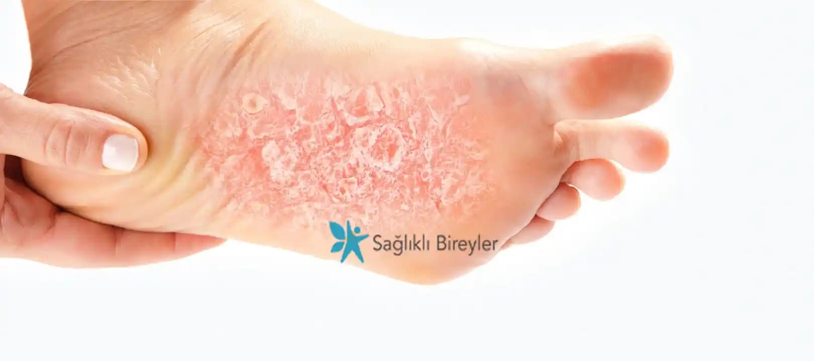 Ayak Altında Egzama Belirtileri ve Kozmetik Seçenekleri Hakkında Bilmeniz Gerekenler
