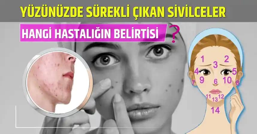 Ayak Altındaki Sivilcelerin Nedenleri Belirtileri ve Etkili Çözüm Yöntemleri