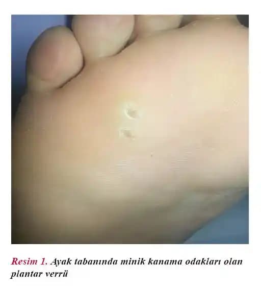 Ayak Tabanı Nasırları Nedenleri Belirtileri ve Etkili Tedavi Yöntemleri