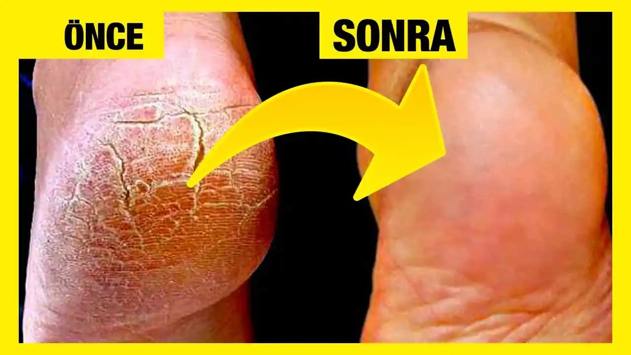 Ayak Topuğu Çatlaklarına Karşı Etkili Bakım Yöntemleri ve Çözüm Önerileri