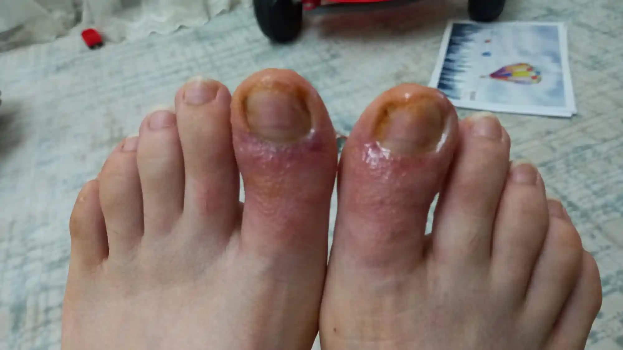 Ayak Üstü Egzama Belirtileri, Nedenleri ve Etkili Bakım Yöntemleri Hakkında Kapsamlı Bilgi