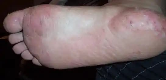 Ayaklarda Egzama Nedenleri, Belirtileri ve Kozmetik Yaklaşımlarına Güncel Rehber