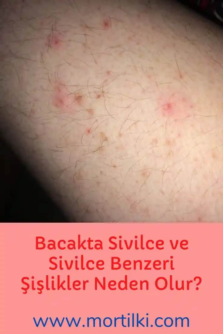 Bacak Arasında Sivilce Nedenleri ve Etkili Çözüm Yolları Hakkında Detaylı Bilgi