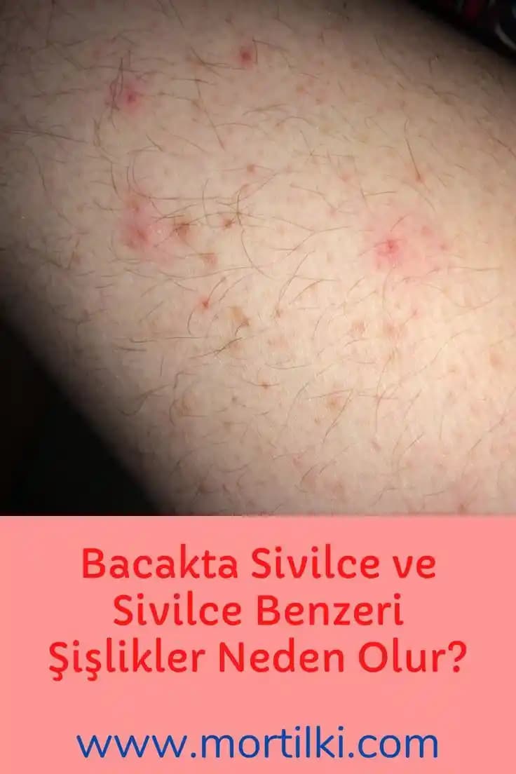 Bacak Arasında Sivilce Nedenleri ve Etkili Çözüm Yolları Hakkında Detaylı Bilgi