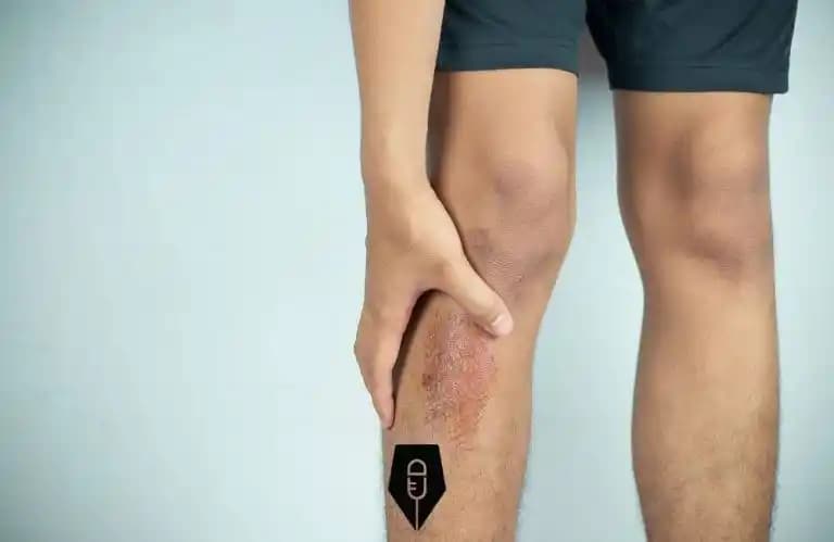 Bacak Yara İzleri Nasıl Geçer? Etkili Yöntemler ve Tavsiyeler