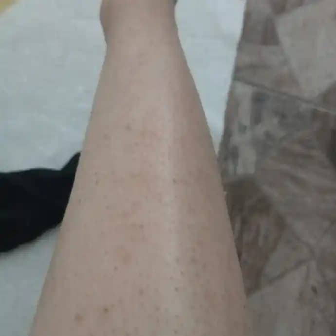 Bacaklarda Siyah Lekeler: Nedenleri, Tedavi Yöntemleri ve Bakım İpuçları