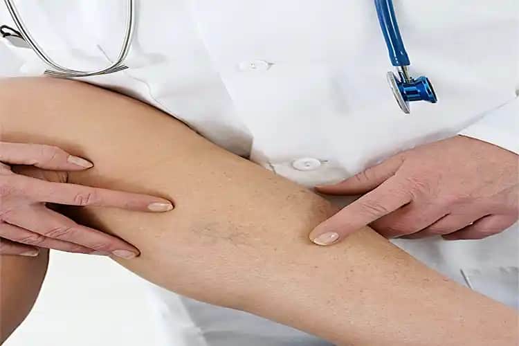 Bacaklardaki Güneş Lekelerini Önleme ve Tedavi Yöntemleri Hakkında Bilgiler