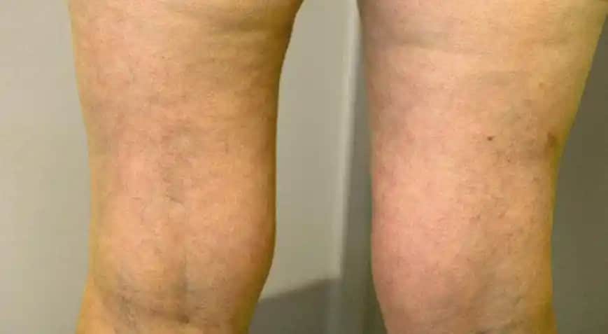 Bacaklardaki Renk Eşitsizliği ve Kozmetik Çözüm Yolları Hakkında Bilgilendirici Rehber