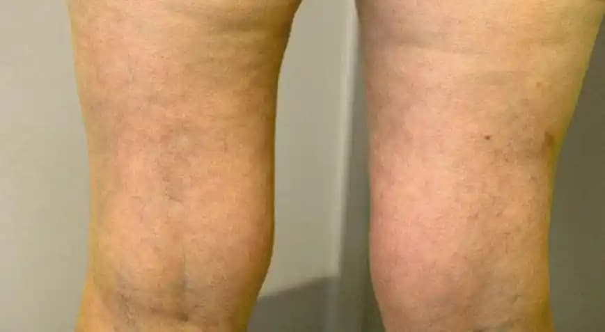Bacaklardaki Renk Eşitsizliği ve Kozmetik Çözüm Yolları Hakkında Bilgilendirici Rehber