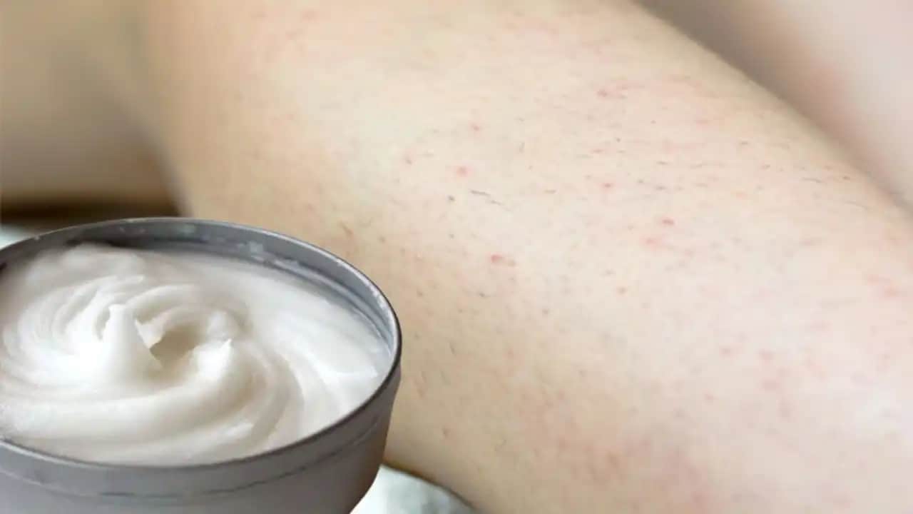 Bacaklardaki Yırtıkların Önlenmesi ve Tedavi Yolları Cilt Sağlığını Koruma Rehberi