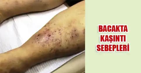 Bacakta Kaşıntı ve Yara Nedenleri ve Korunma Yöntemleri