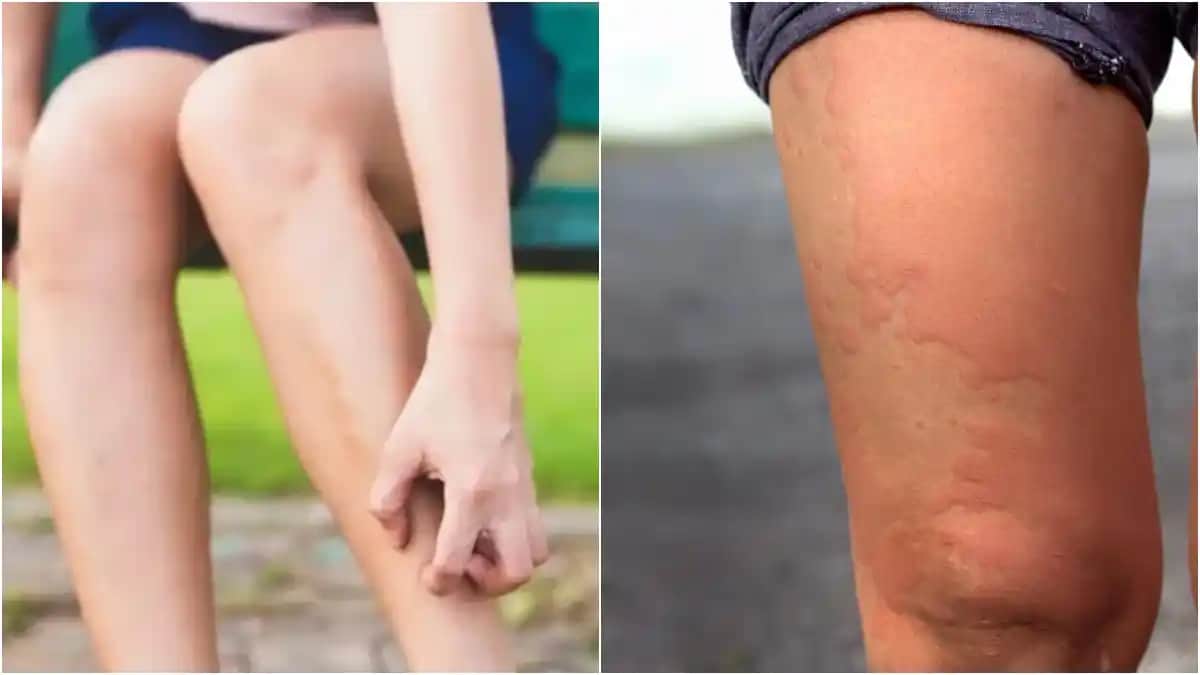 Bacakta Kaşıntılı Yaralar: Nedenleri, Belirtileri ve Tedavi Yöntemleri