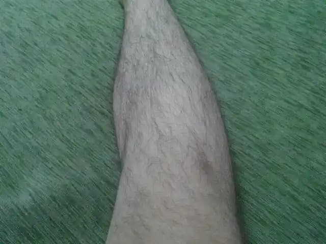 Bacakta Kısmi Kıl Dökülmesinin Nedenleri ve Etkili Bakım Yöntemleri