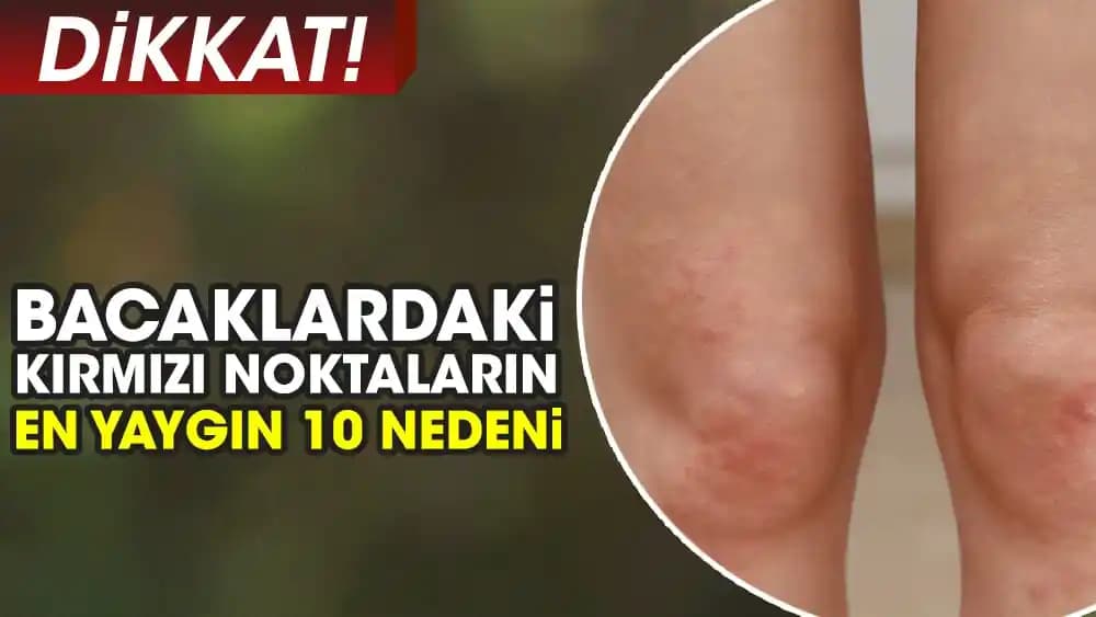 Bacakta Lekelerin Nedenleri ve Etkili Tedavi Yöntemleri Hakkında Güncel Bilgiler