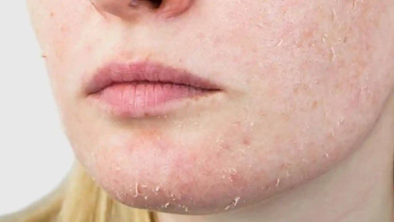 Bacakta Pul Pul Dökülmenin Nedenleri ve Etkili Tedavi Yöntemleri