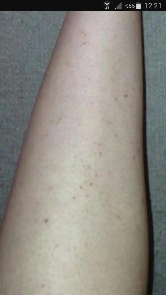 Başta Siyah Kıl Kökleri Nasıl Geçer ve Kalıcı Çözüm Yöntemleri Nelerdir