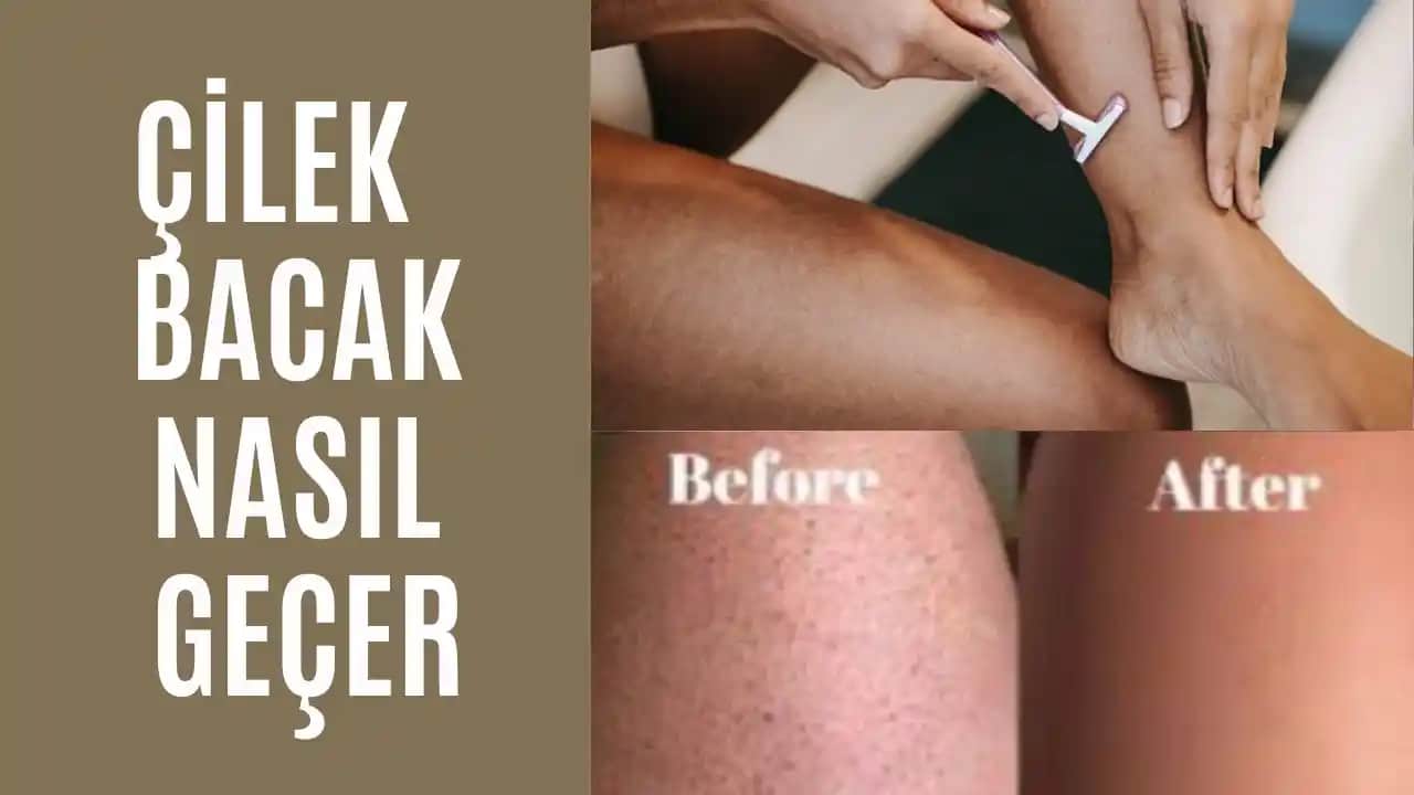 Batık ve Çilek Bacak Sorunlarına Karşı Etkili Çözüm Yöntemleri ve Günlük Bakım İpuçları