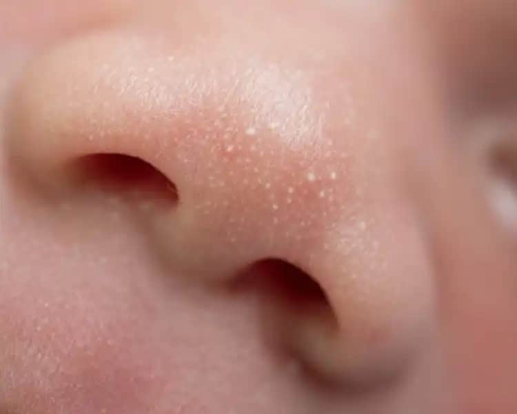 Bebek Yüzündeki Beyaz Lekelerin Nedenleri ve Uygun Tedavi Yöntemleri