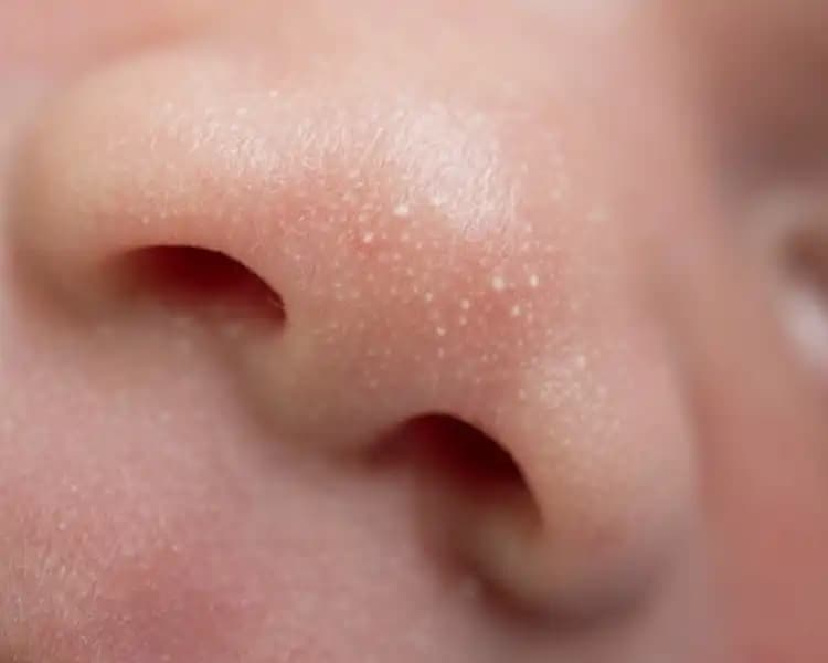 Bebek Yüzündeki Beyaz Lekelerin Nedenleri ve Uygun Tedavi Yöntemleri