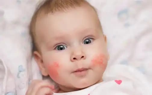 Bebeklerde Atopik Dermatite Yönelik Kozmetik Yaklaşımlar ve Güvenli Ürün Seçimi