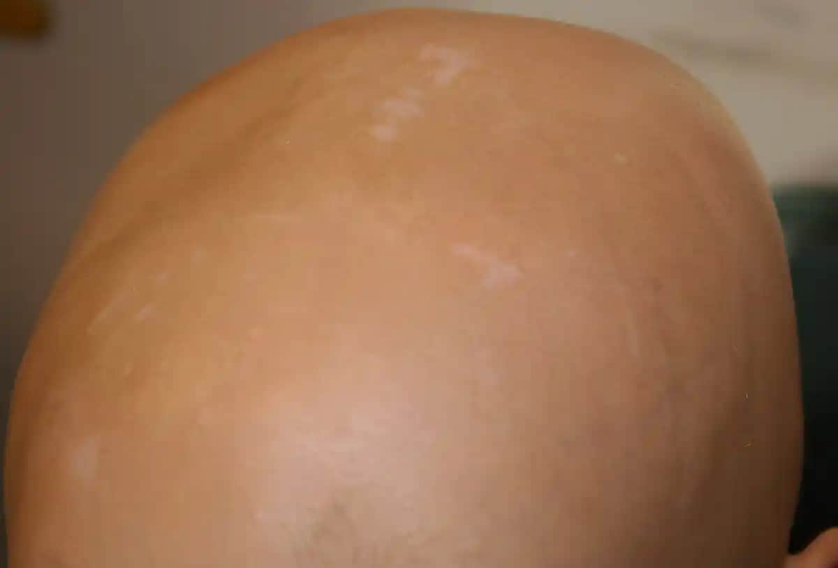 Bebeklerde Beyaz Lekelerin Nedenleri Tanısı ve Kozmetik Yaklaşımlar