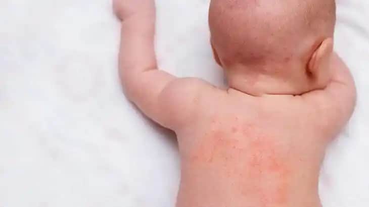 Bebeklerde Boyun Kızarıklığına Nedenler Belirtiler ve Korunma Yöntemleri