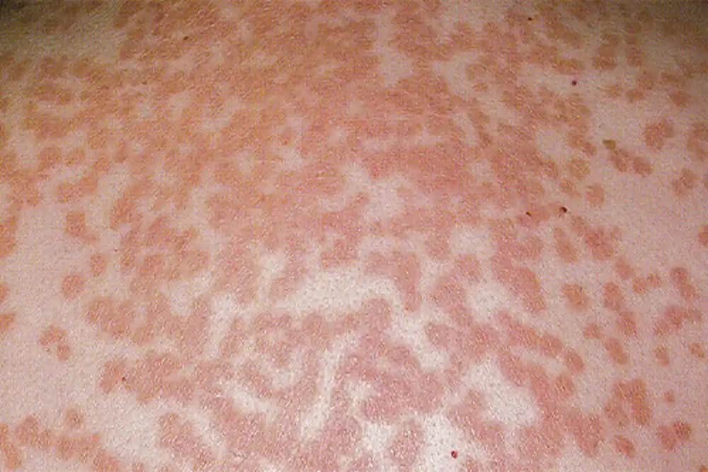 Bebeklerde Mantar Enfeksiyonu: Belirtileri, Nedenleri ve Koruma Yöntemleri