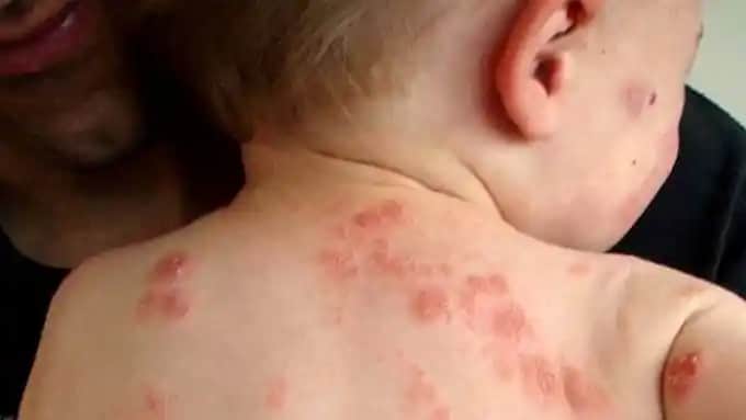 Bebeklerde Sedef Hastalığı: Belirtileri, Tanısı ve Önleyici Yöntemler