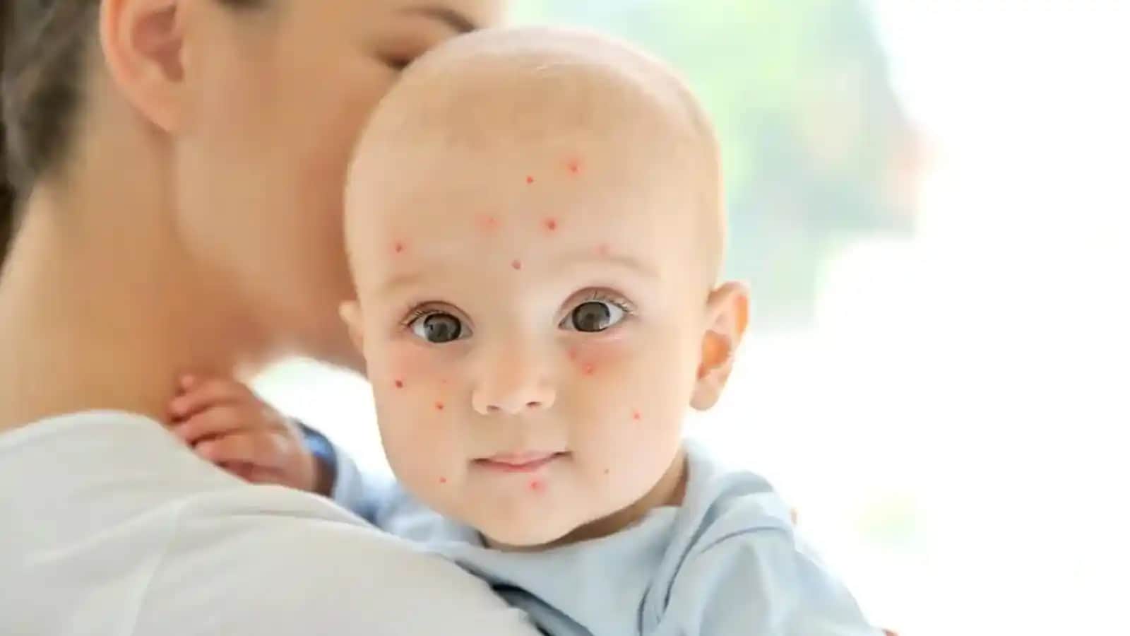 Bebeklerde Yanakta Sivilce Nedenleri ve Doğru Bakım Yöntemleri Hakkında Bilgi