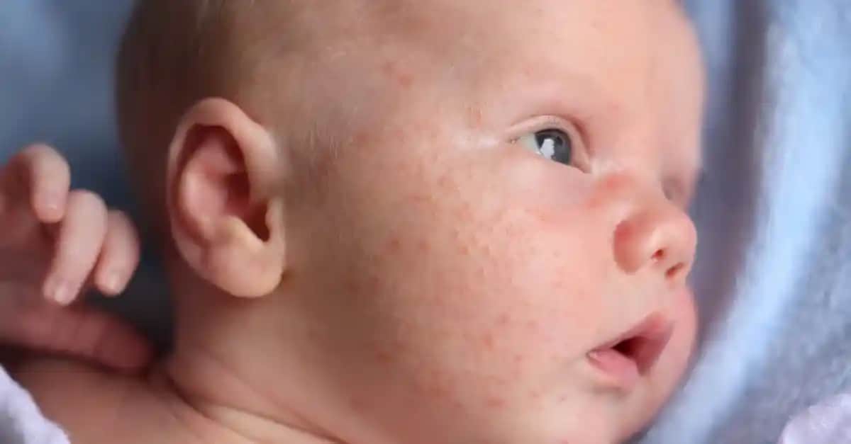 Bebeklerde Yüz Sivilceleri Nedenleri Türleri ve Uygun Bakım Yöntemleri