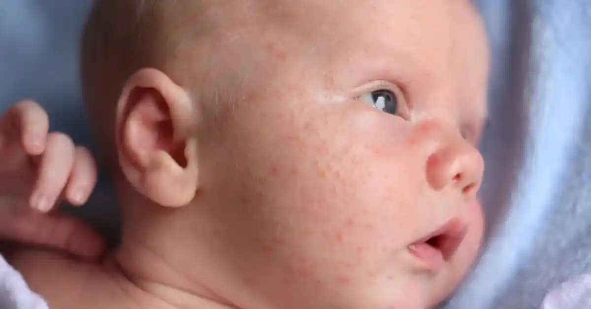 Bebeklerde Yüz Sivilceleri Nedenleri Türleri ve Uygun Bakım Yöntemleri