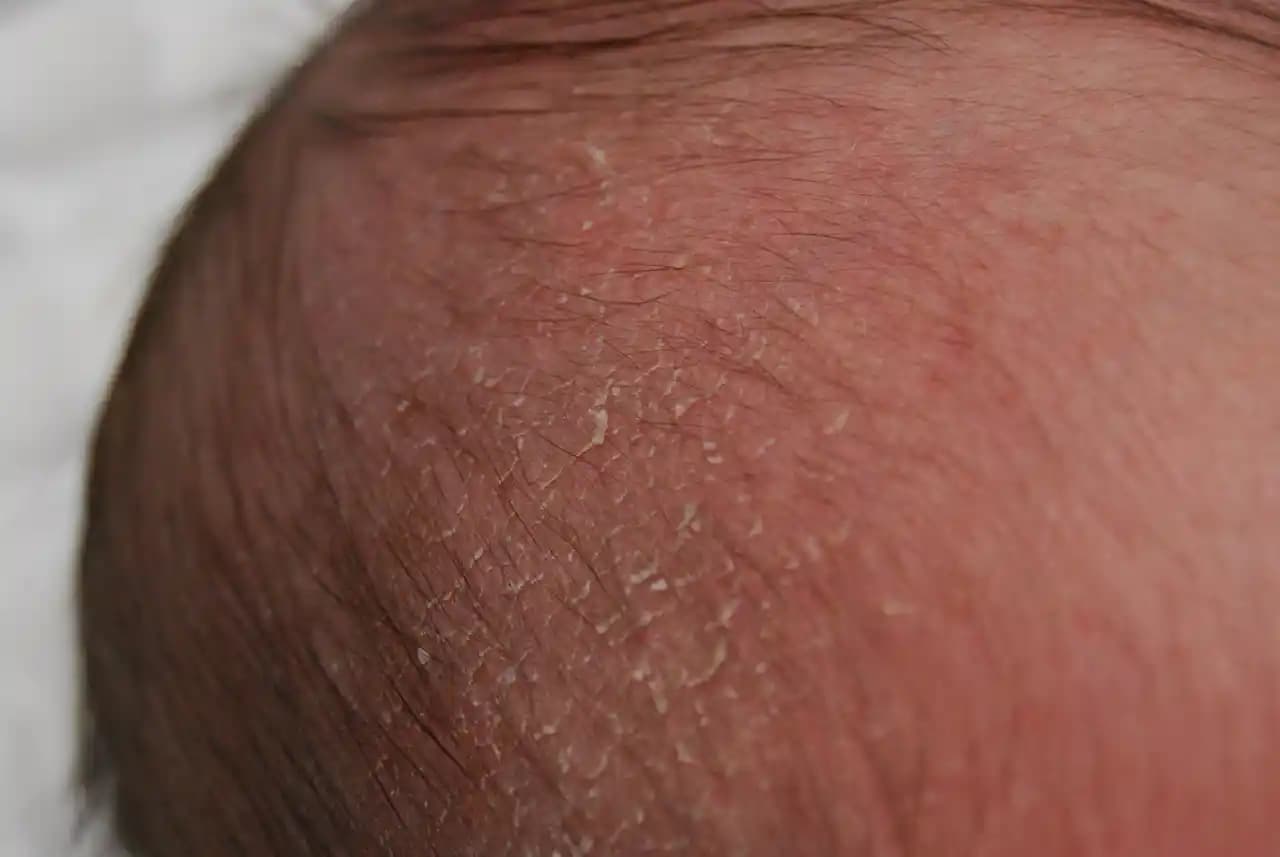 Bebeklerin Kafasında Kabuklanma Nedenleri ve Güvenli Çözüm Yolları