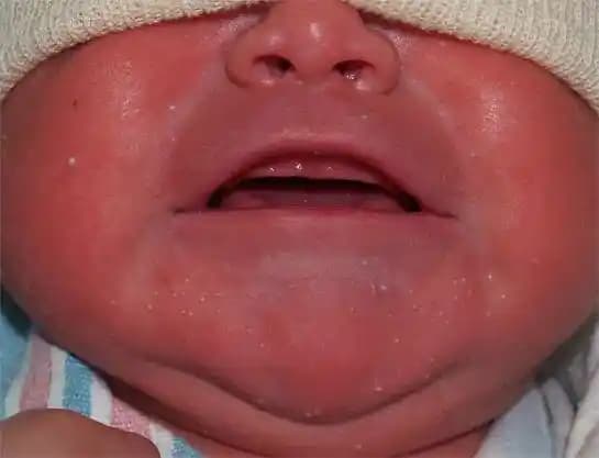 Bebeklerin Yüzündeki Beyaz Noktalar: Nedenleri ve Güvenli Bakım Yöntemleri