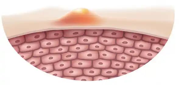 Belde Sivilcesinin Nedenleri, Belirtileri ve Etkili Çözüm Yöntemleri