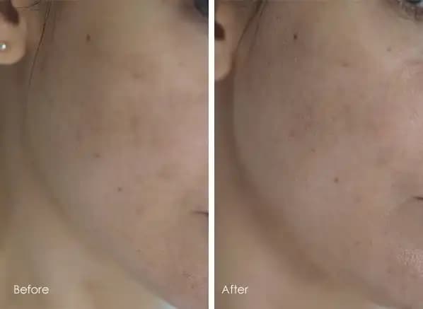 Bioderma PigmentBio Sensitive Areas ile Hassas Bölgelerde Pigmentasyon ve Renk Eşitliği Sağlama