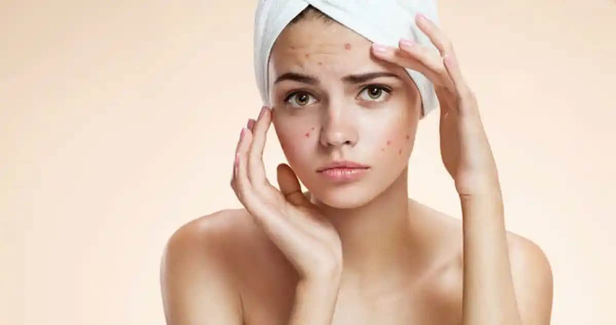 Bölgelere Göre Sivilce Problemleri ve Etkili Bakım Yöntemleri