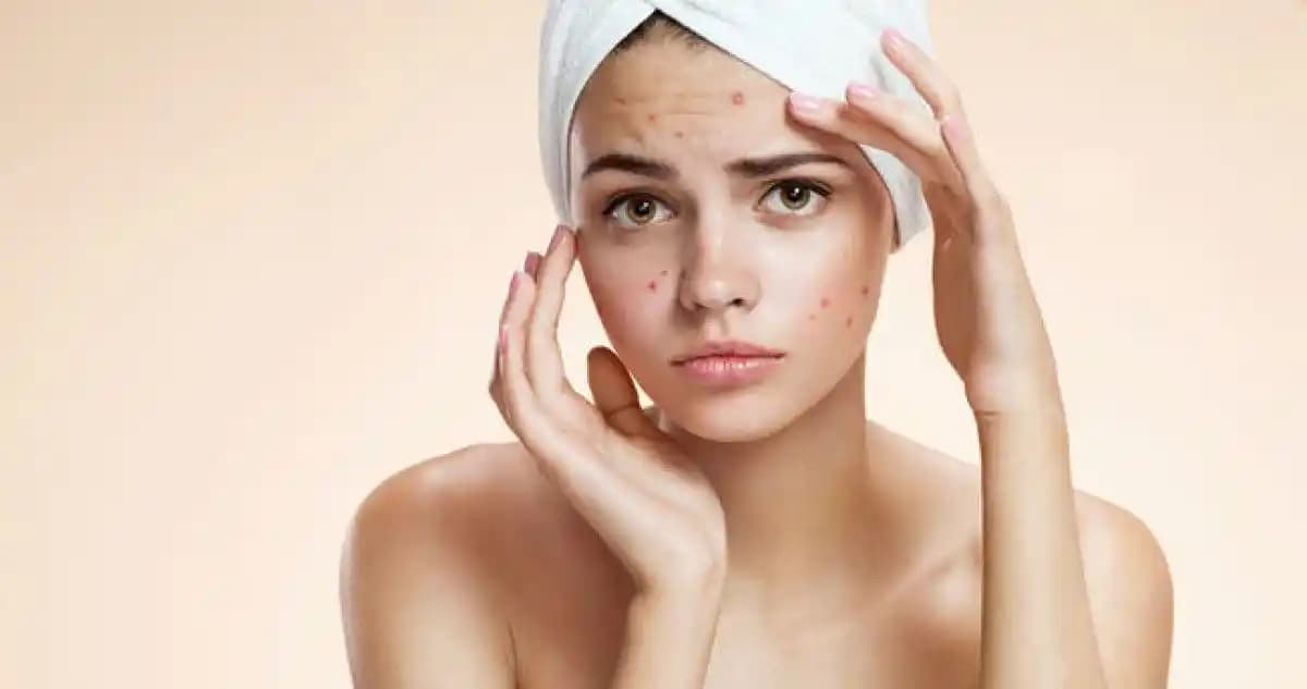 Bölgelere Göre Sivilce Problemleri ve Etkili Bakım Yöntemleri