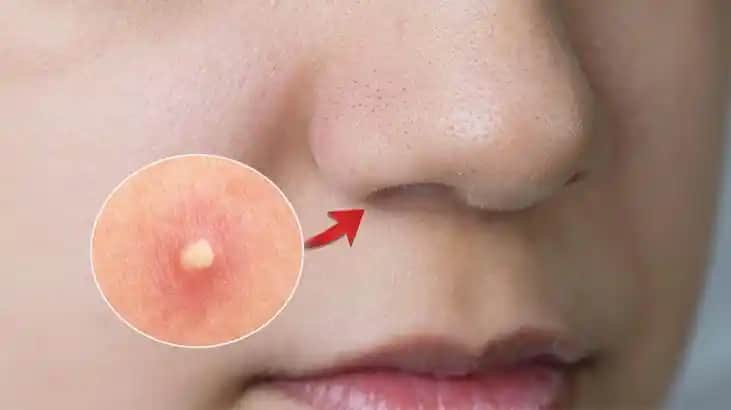 Burun Altı Sivilceleri: Nedenleri, Korunma Yöntemleri ve Kozmetik Çözümler