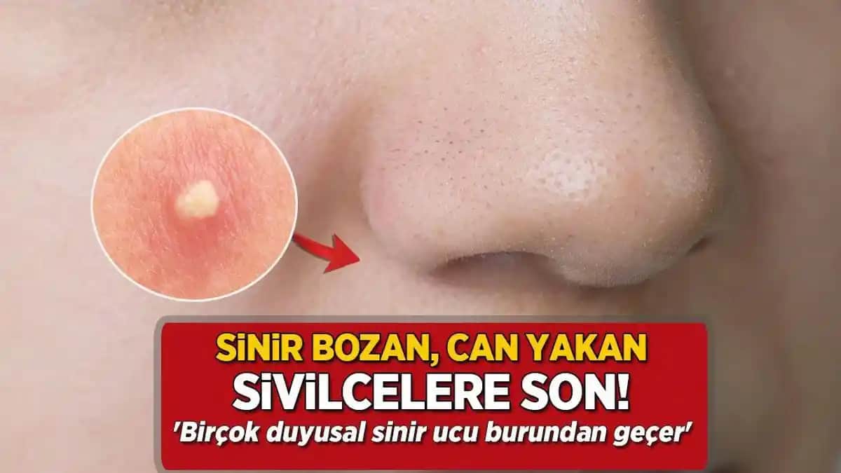 Burun Bölgesinde Sivilce Nedenleri ve Etkili Önleme Yöntemleri Hakkında Kapsamlı Rehber