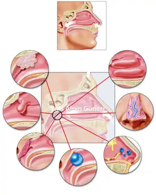 Burun İçi İltihaplarının Nedenleri, Belirtileri ve Kozmetik Etkileri Üzerine Kapsamlı Bir Analiz
