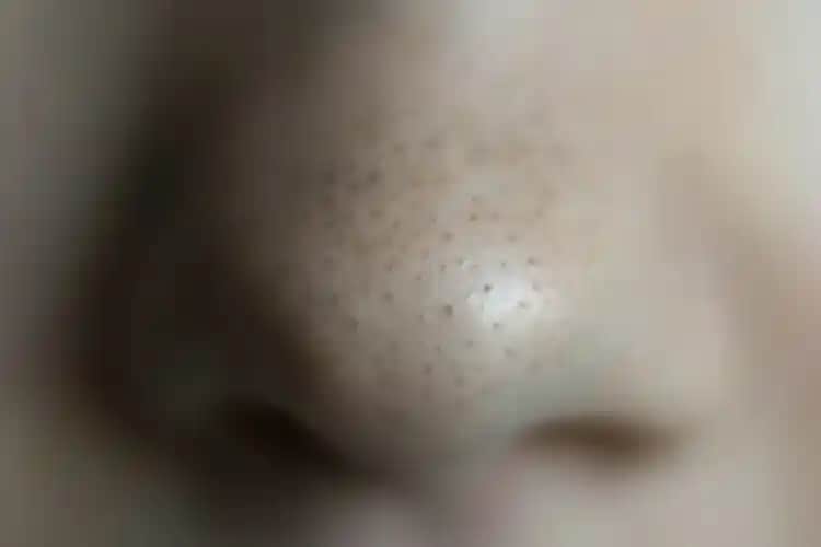 Burun Üzerindeki Deliklerin Görünümünü Azaltmanın Etkili Yöntemleri ve Uzman Tavsiyeleri