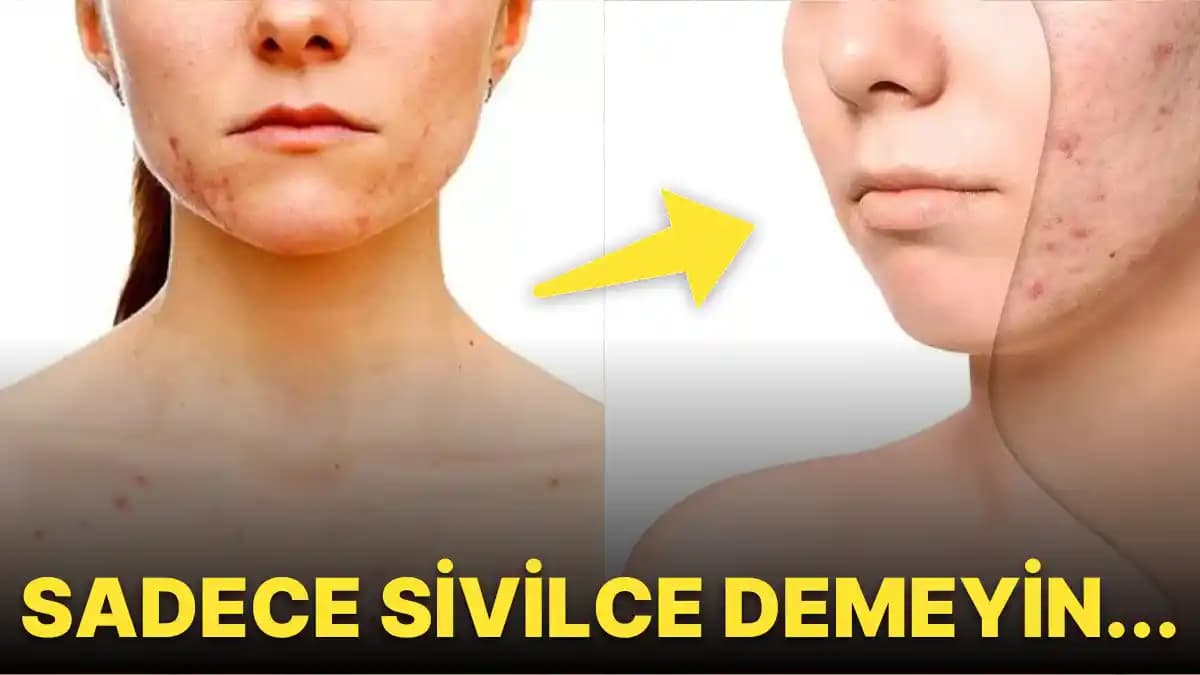 Burunda Sivilce Çıkma Nedenleri ve Etkili Çözüm Yolları Hakkında Kapsamlı Bilgi