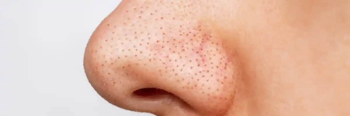 Burundaki Kapalı Komedonların Nedenleri, Belirtileri ve Etkili Çözüm Yöntemleri